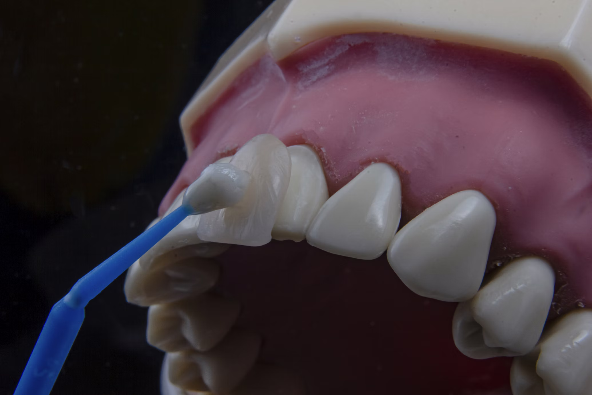 Clean and polish treatment at Otahuhu Dental Care
