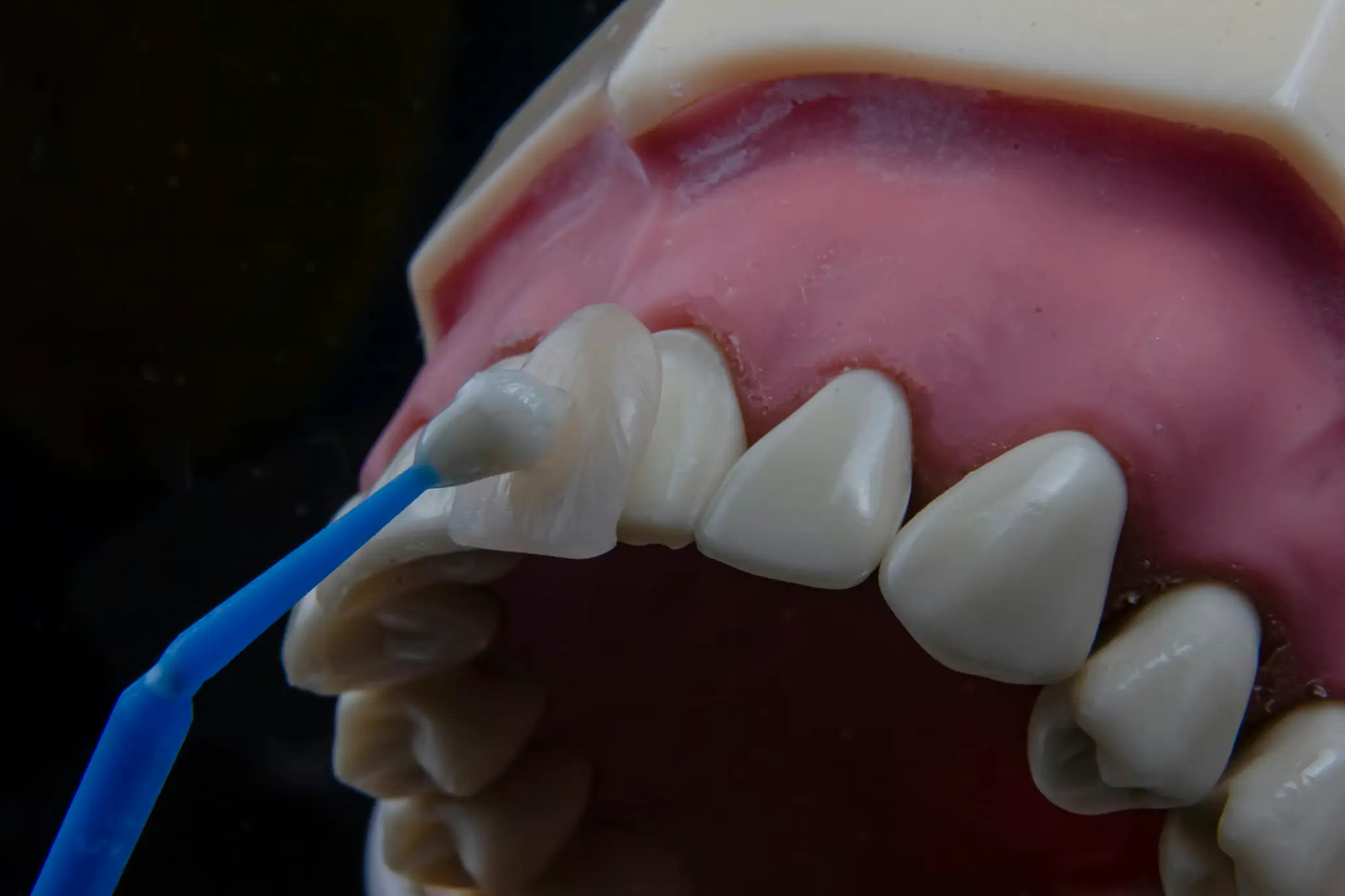 Scaling and Polishing